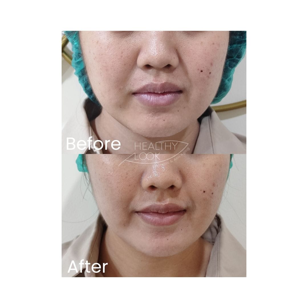 before after treatment
