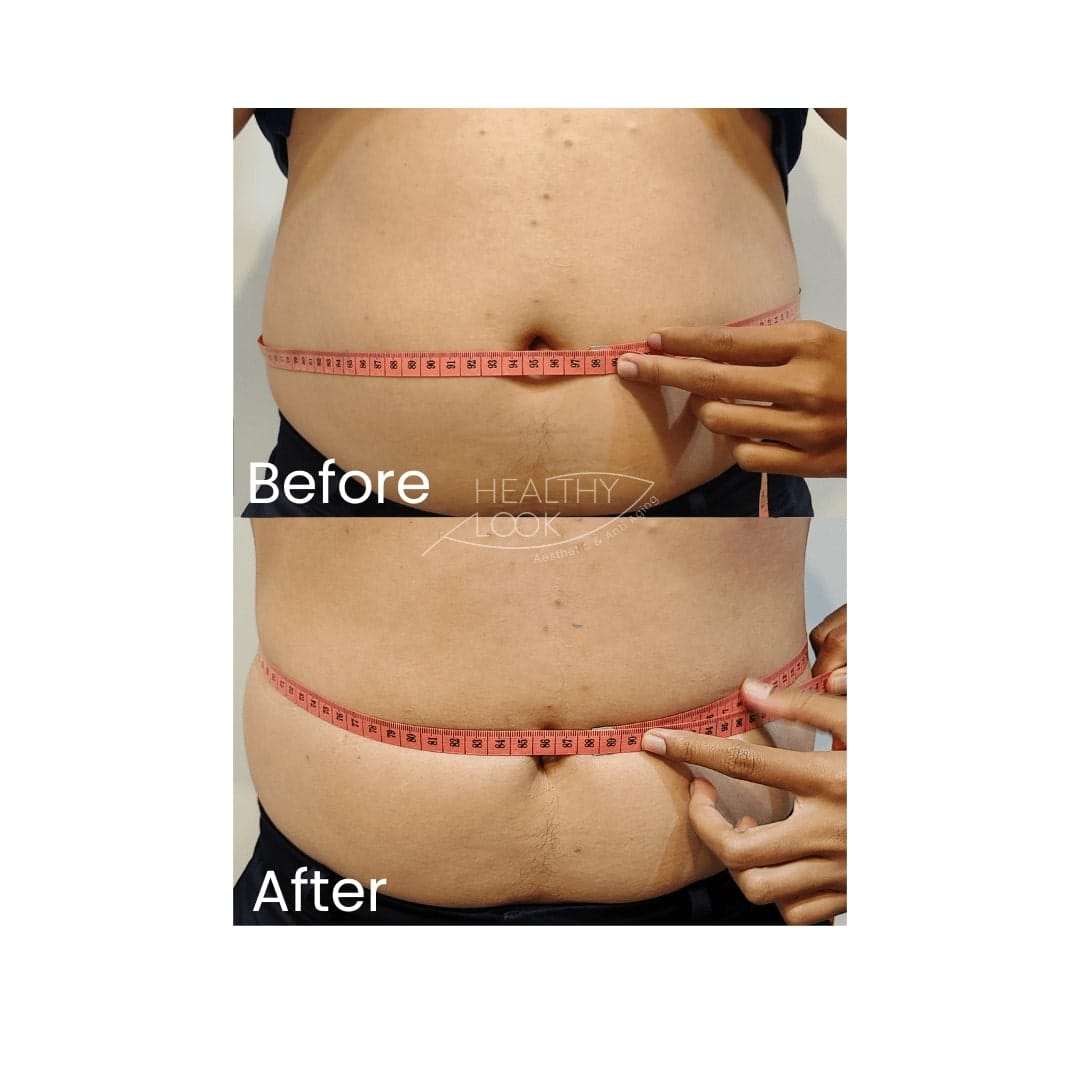 before after treatment