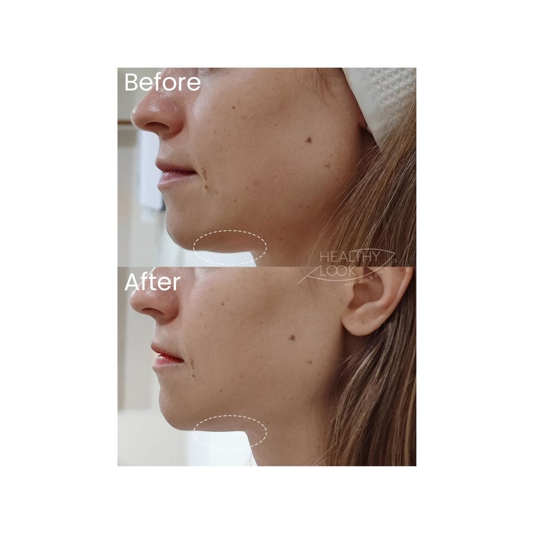 before after treatment