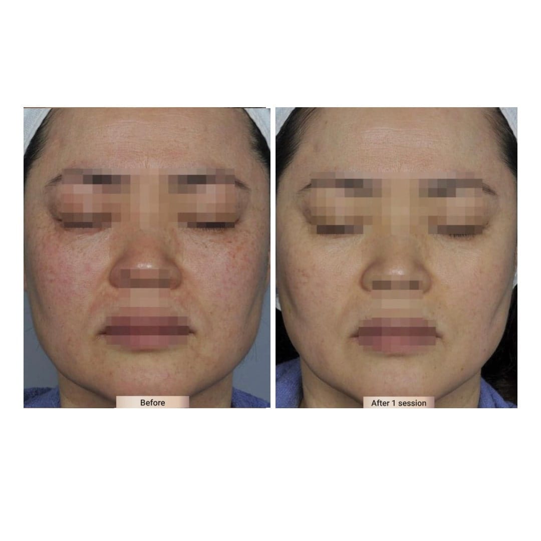 before after treatment