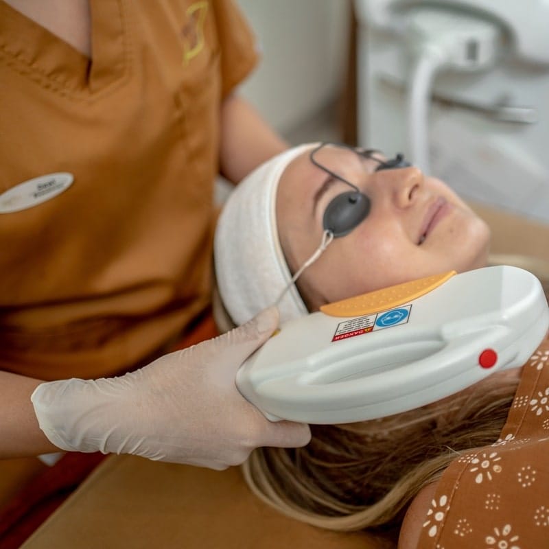 IPL treatment