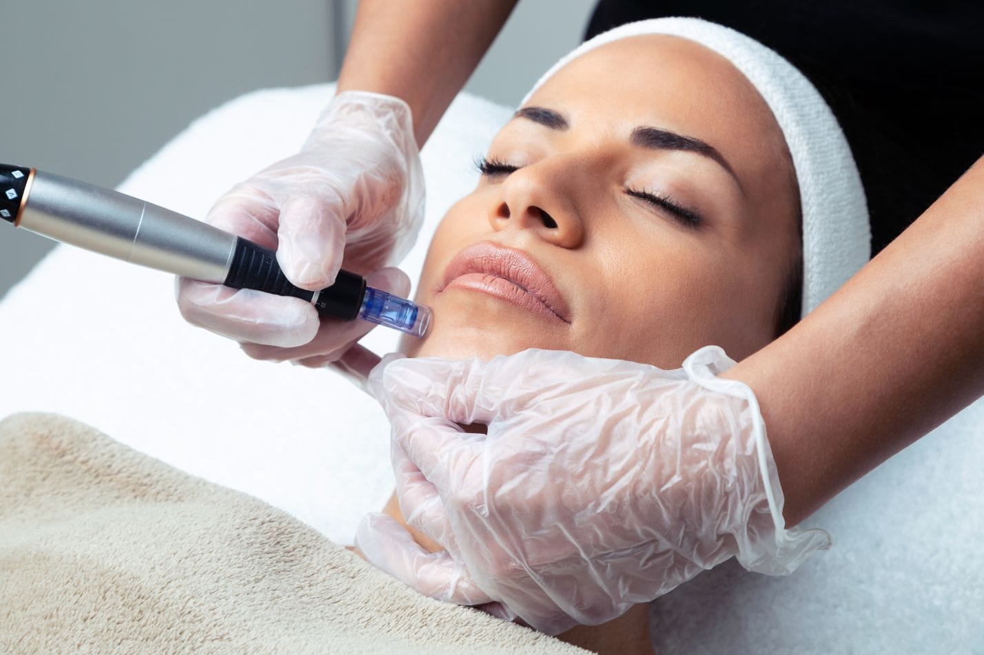 Microneedling treatment