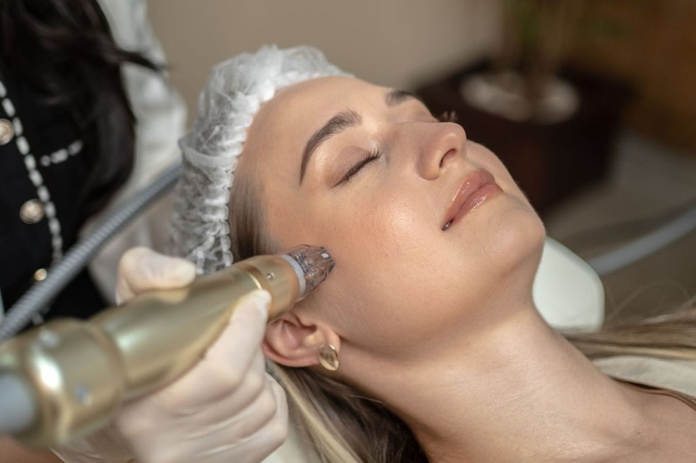 Microneedling treatment